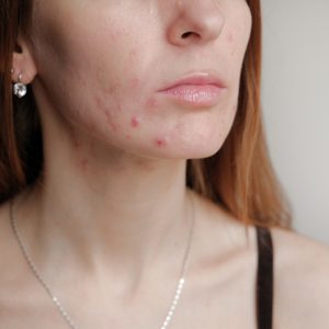 cropped photo of woman with acne on face