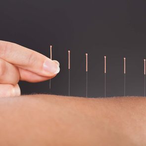 What_Is_Acupuncture