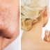 Dr. Pimple Popper Reveals How to Finally Get Rid of Those Pesky Blackheads