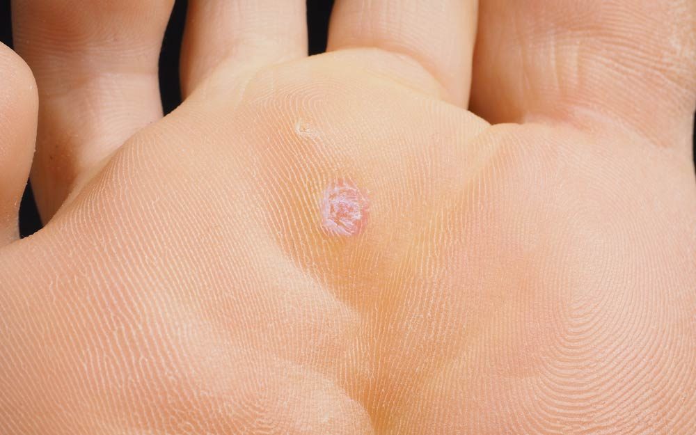 Yes, You Can Remove a Plantar Wart with Duct Tape