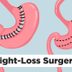 The Top Weight-Loss Surgery Proceduresâ€”Ranked and Demystified