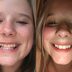 How I Straightened My Teeth Without Braces