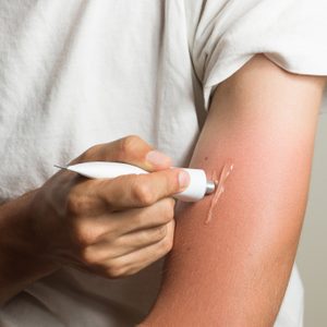 man applying gel to sunburn on arm cropped shot