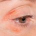 8 Tips for Dealing With Psoriasis on Your Eyelids