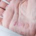 18 Things You Should Know About Palmoplantar Psoriasis