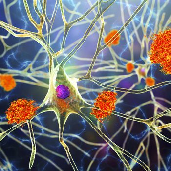 Nerve cells affected by Alzheimer's disease, illustration